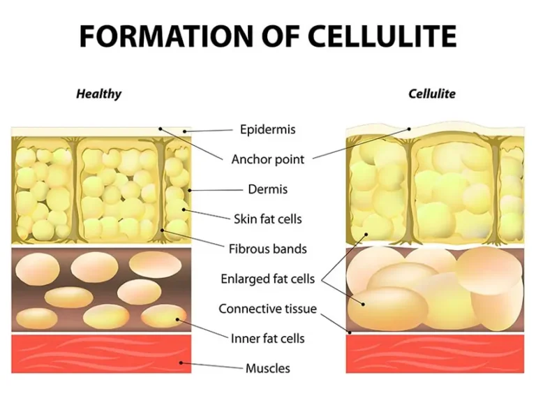 foto cellulite donna