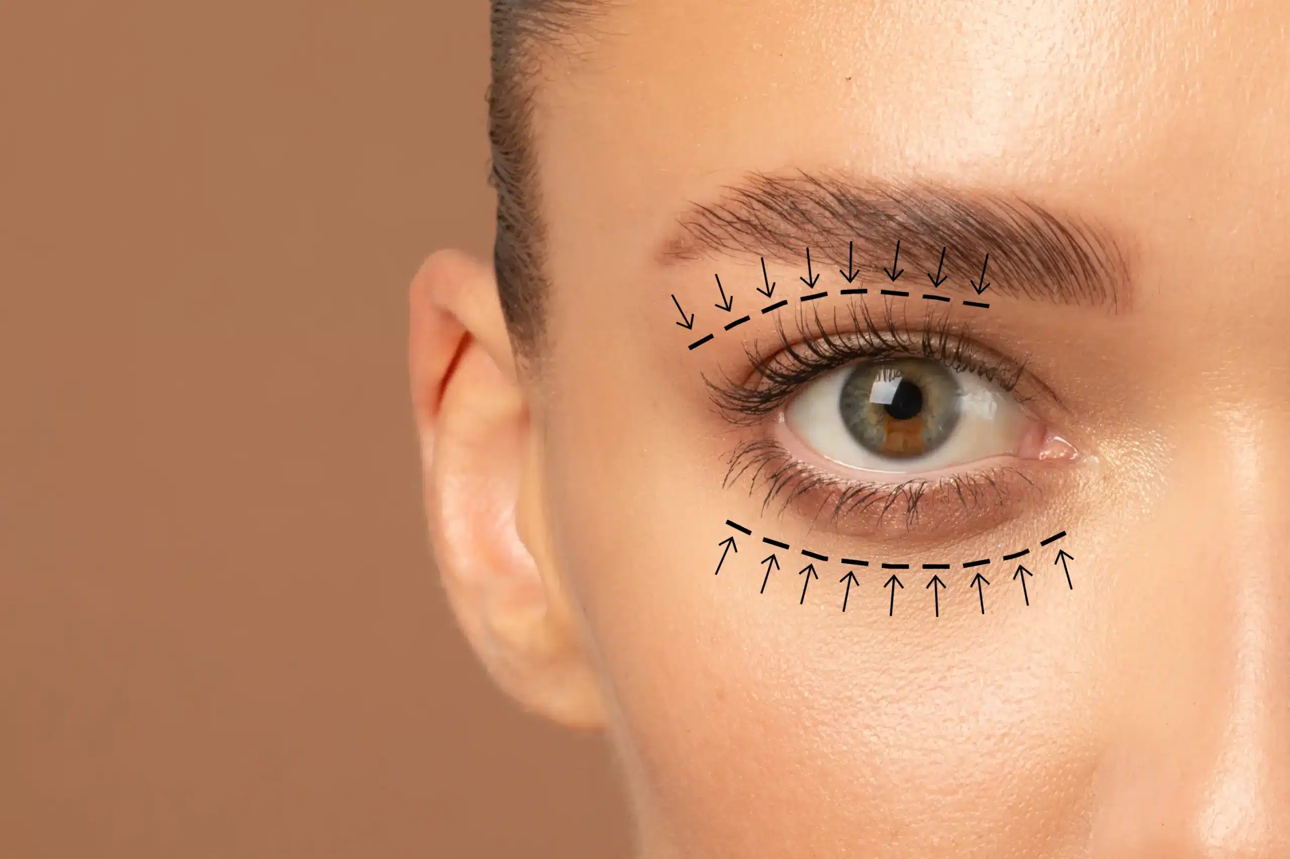 Blepharoplasty scars