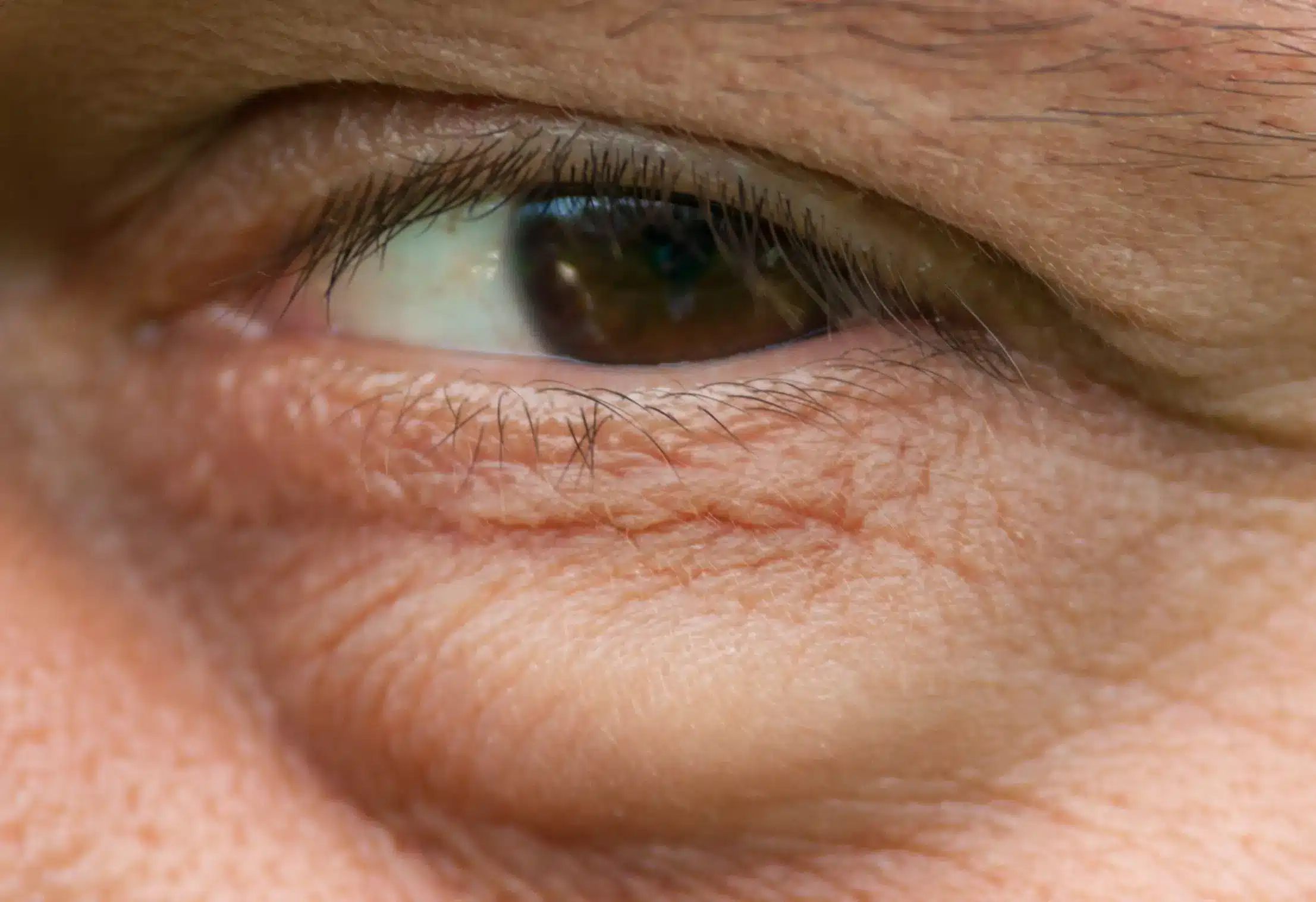 Wrinkles in men