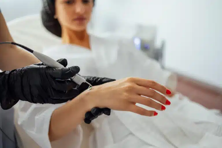 photograph of laser hand rejuvenation