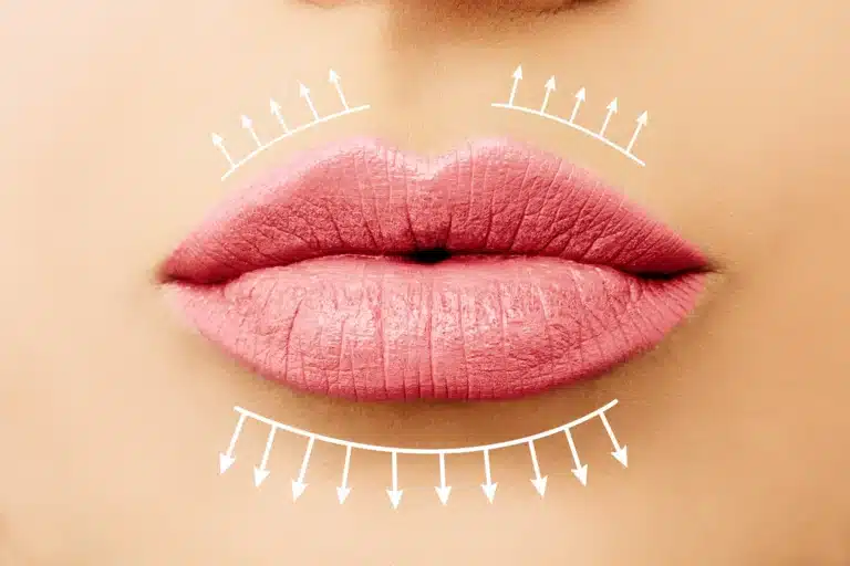 foto aumento delle labbra con Russian lips