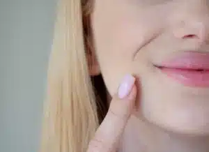 Nasolabial fold treatment