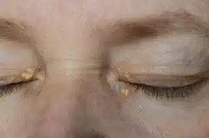 Brown spot treatment
