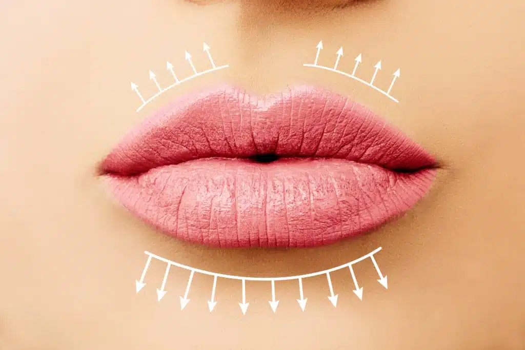 photo augmentation of the lips by Russian lips