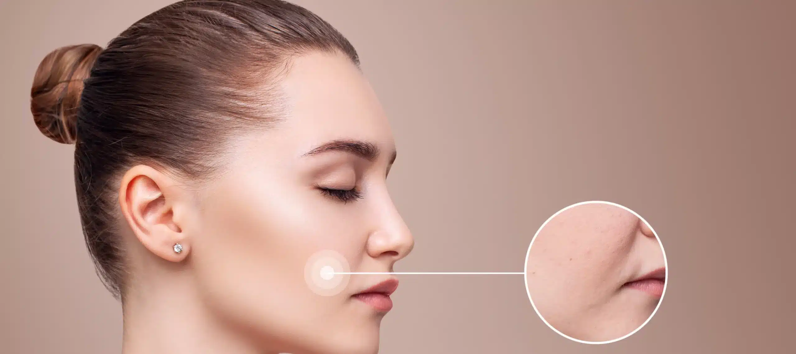Nasolabial fold treatment