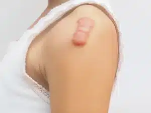 photo keloid scar
