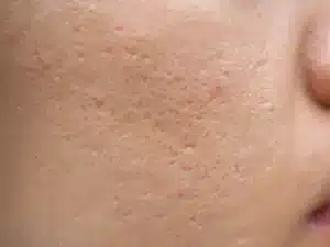 photo hollow acne scar