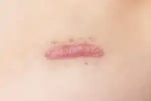photo hypertrophic scar