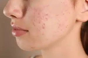 photo red scar