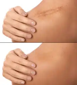 Brown spot treatment