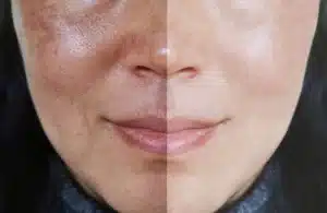 Brown spot treatment